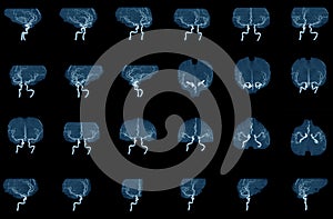 MRA and MRI  image of blood vessels in brain for a medical diagnosis cerebrovascular or hemorrhagic stroke