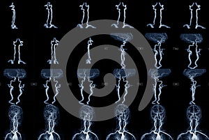 MRA and MRI  image of blood vessels in brain for a medical diagnosis cerebrovascular or hemorrhagic stroke