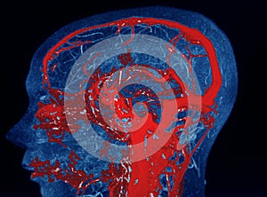 MRA AND MRV OF BRAIN Finding:Bilateral territorial muscles to the cortex and subcortical of the parietal and low hemispheres