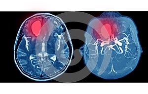 MRA AND MRV OF BRAIN Multiple acute intracranial hemorrhage at bilateral frontal lobes