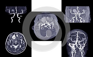 MRA AND MRV OF BRAIN:, presented with intracranial hemorrhage.This study was sent to evaluate intracranial vascular abnormality at