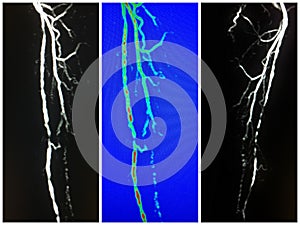 Mra superficial femoral artery occlusion collage photo