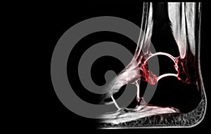 MRI Ankle  Sagittal view showing white cartilage and  black bone