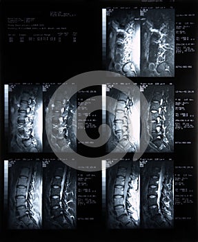 MRI of back