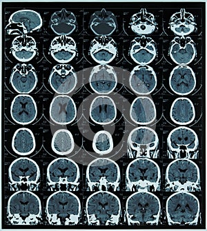 MRI of brain
