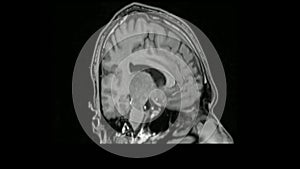 MRI Brain 3D Rotation