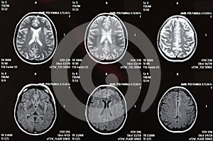 MRI of a brain