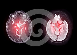 MRI  brain  axial diffusion image  for detect stroke disease . photo