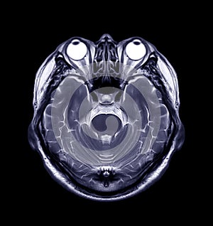 MRI of the brain Axial T2