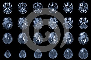 MRI Brain Axial views .to evaluate brain tumor. Glioblastoma, brain metastasis isodensity mass with an ill-defined margin and photo
