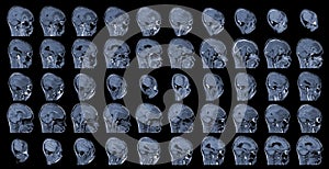 MRI Brain Axial views .to evaluate brain tumor. Glioblastoma, brain metastasis isodensity mass with an ill-defined margin and photo