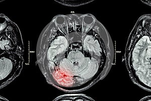 MRI of brain : brain injury photo