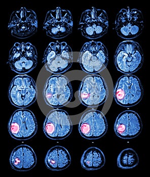 MRI brain : Brain tumor at right parietal lobe photo