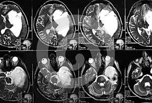 MRI of the brain, brain tumor - MR photo