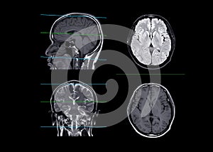 MRI brain compare axial, coronal and sagittal plane photo