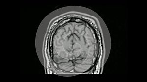 MRI Brain Coronal Navigation