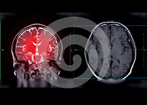 MRI brain Coronal T2W plane for detect stroke disease . photo