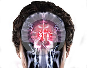MRI brain Coronal T2W and MRA Brain fusion  in Coronal view