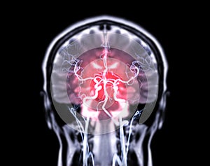 MRI brain Coronal T2W and MRA Brain fusion  in Coronal view