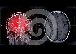 MRI brain Coronal T2W plane for detect stroke disease .