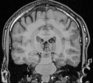 MRI Brain Coronal View