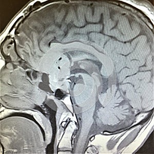 Mri brain exam pituitary pathology