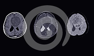 MRI BRAIN Finding of meningioma arising from anterior falx cerebri, extending to bilateral frontal regions, with adjacent minimal
