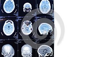 MRI of the brain . Human health. X-ray image. MRI scan or magnetic resonance image of head and brain scan