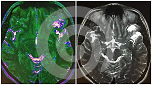 Mri brain inferior frontal dnet structure collage