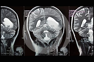 MRI of brain, left hemisphere tumor, coronal plane photo