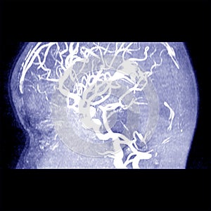 MRI THE BRAIN.Moderate perilesional vasogenic edema with 0.7 cm midline shift to the left side.Medical image concept