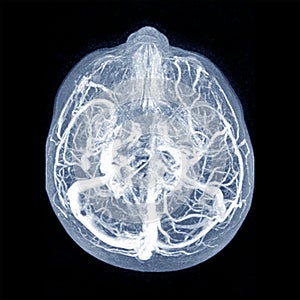 MRI THE BRAIN.Moderate perilesional vasogenic edema with 0.7 cm midline shift to the left side.Medical image concept