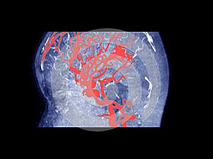 MRI OF THE BRAIN AND MRA & MRV OF THE BRAIN