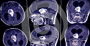 MRI Brain and orbits . showing a3.5cm. suprasellar mass cause mass