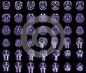 MRI brain, x-ray film of the brain, computed tomography