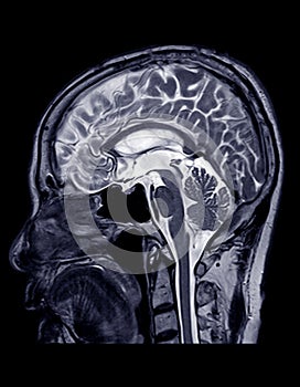 MRI of the brain sagittal plane. photo