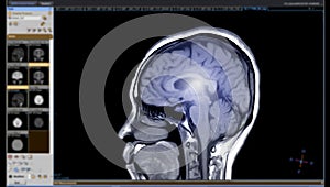 MRI of the brain Sagittal T1