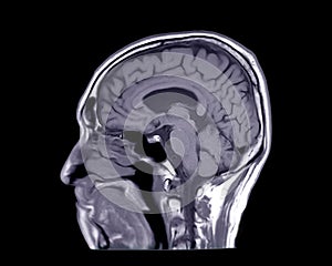 MRI of the brain sagittal T1 view
