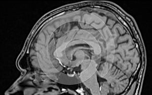 MRI Brain Sagittal View photo