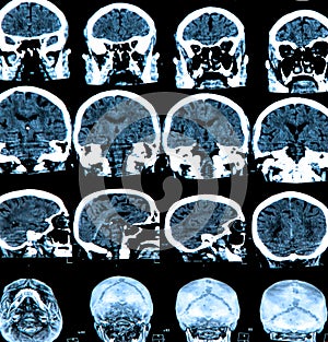 Mri Brain Scan