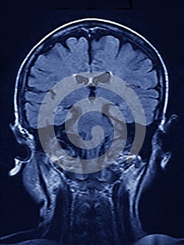 MRI brain Scan photo