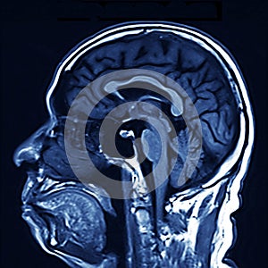 MRI Brain Scan photo