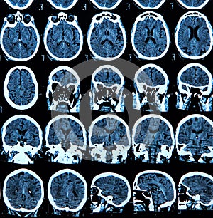 Mri Brain Scan