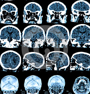 Mri Brain Scan