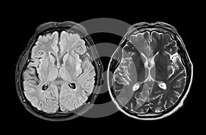 MRI  brain scan  axial T1W for detect  Brain  diseases sush as stroke disease, Brain tumors and Infections photo