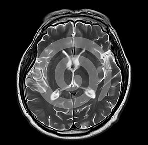 MRI  brain scan  axial T2W  for detect  Brain  diseases sush as stroke disease, Brain tumors and Infections photo
