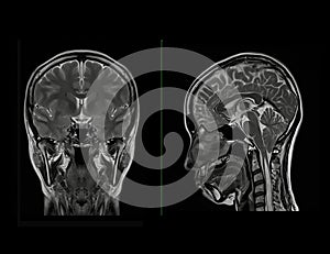 MRI  brain scan  Compare Coronal and sagittal plane for detect  Brain  diseases sush as stroke disease, Brain tumors and