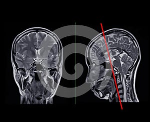 MRI  brain scan  Compare Coronal and sagittal plane for detect  Brain  diseases sush as stroke disease, Brain tumors and