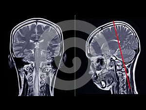 MRI  brain scan  Compare Coronal and sagittal plane for detect  Brain  diseases sush as stroke disease, Brain tumors and