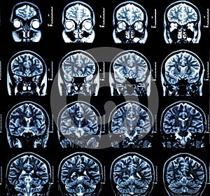MRI Brain Scan